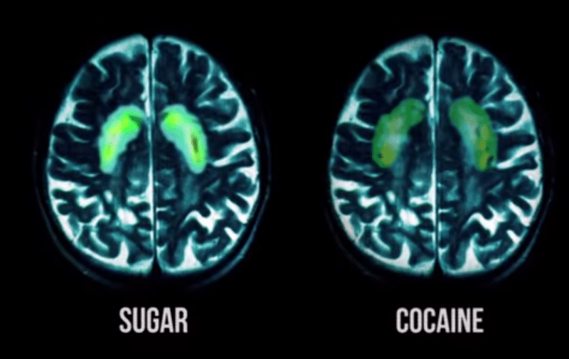 Sugar vs Cocaine Brain Image