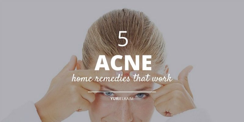 5 Home Remedies for Acne More People Should Know