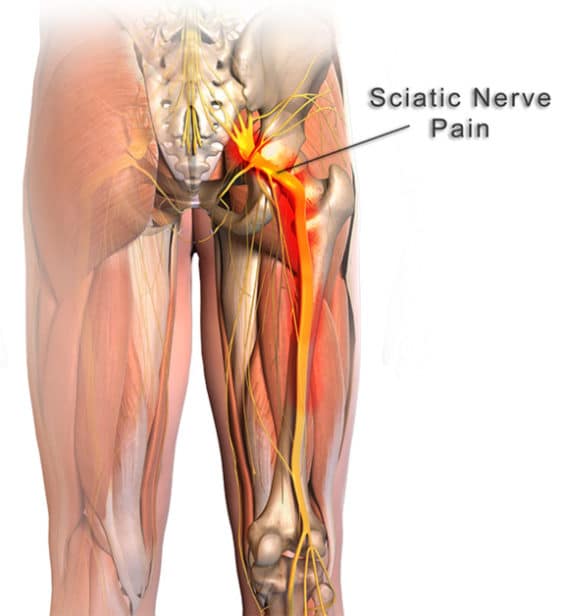 What Can I Do For Sciatic Nerve Pain