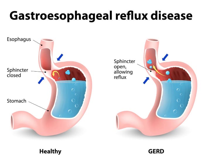 How To Relieve Heartburn Naturally 7 Ways That Actually Work Yuri Elkaim