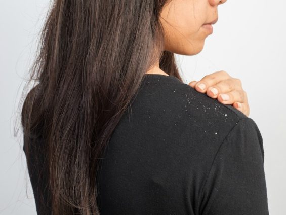 7 Best Natural Remedies for Dandruff