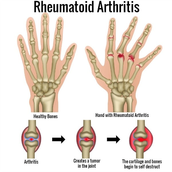 rheumatoid arthritis in the hands