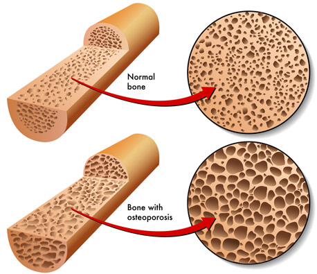 osteoporosis